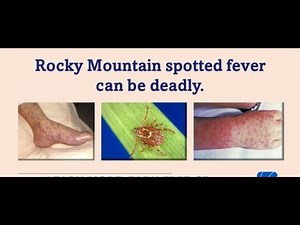 Rocky Mountain Spotted Fever RMSF bacterial disease caused by Rickettsia rickettsii; Symptoms, Treat