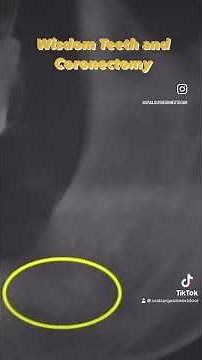 Wisdom Teeth and Coronectomy