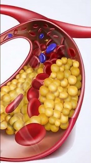Hyperlipidemia is the high levels of lipids cholesterol and triglycerides, in the blood.