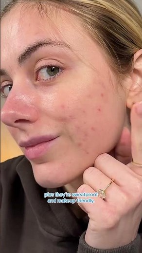 Before and After Differin Acne Prone Skin Patches