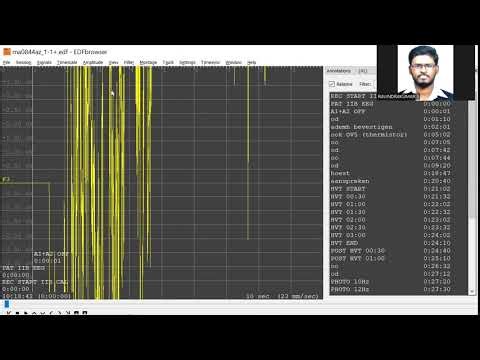 Biomedical Signal Processing -EDF Browser. EEG signal analysis