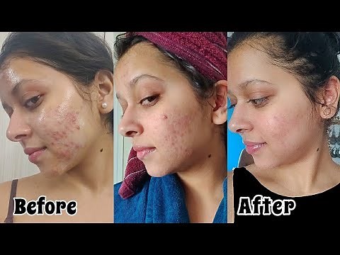 HOW I CLEARED MY ACNE | My Acne to Clear Skin Journey with Pictures | Products/Treatment?