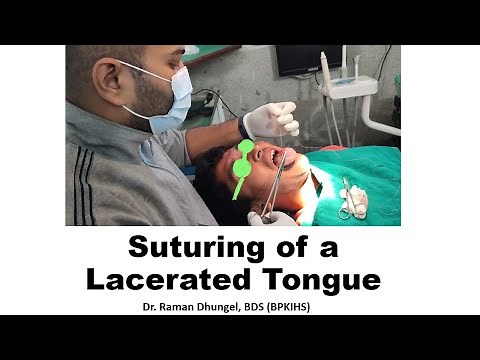 Suturing of a Tongue Bite Injury - Dr. Raman Dhungel