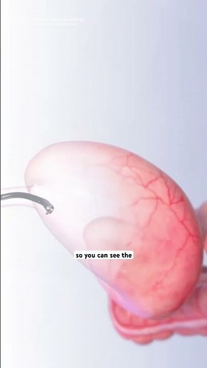 Endoscopic Sleeve Gastroplasty Procedure (3D Animation)