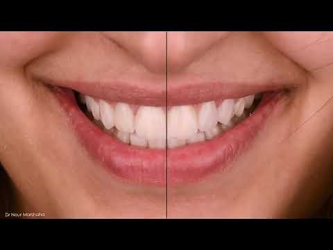 The Concept Of Digital Smile Design And How To Do It. Dr. Nour Marshaha