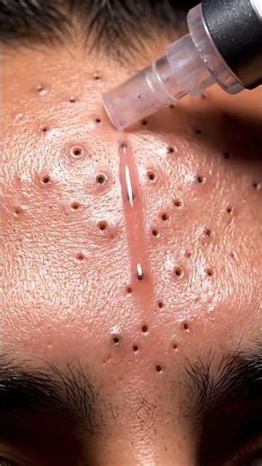 “Millions of Blackheads Gone in Seconds!”