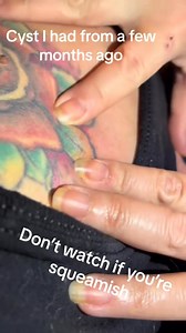 #pimplepop #cystpopping #cyst #gross | Sirius Rydstorm