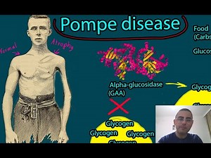 Pompe disease - Symptoms, Causes, Treatment Prognosis