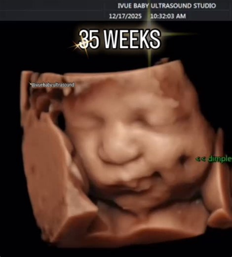 ivue (i-view) baby 2D/3D/4D/5DHD/8K ultrasound studio 🤎 on Instagram: "35 WEEKS CONTINUES TO AMAZE ME. I MEAN, DO WE EVEN NEED THE 8K AT THIS POINT ! HER DIMPLE WAS SO CLEAR 🥹#ultrasound #pregnancy #southflorida #pregnant #baby #cute #momtobe #momsofinstagram"