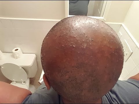 How To Soothe Scalp Inflammation, Bumps and Blisters ( CCCA Alopecia/Folliculitis)