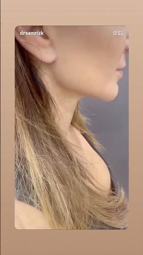 Deep Plane Facelift & Neck Lift: 1.5-Year Results | Dr. Rizk