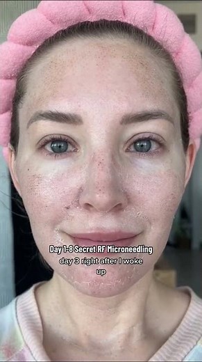 Healing from RF MicroNeedling Day 1-8 Vlog