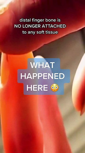 Lesiones en los dedos: Trauma y tratamiento