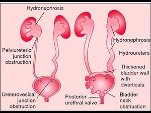Hydroureter, hydropelvis, hydronephrosis & pyonephrosis