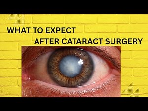 What to expect after cataract surgery (day to day recovery guidelines)
