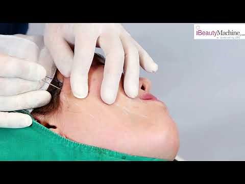 How to use Instalift 6D Cog lift thread | video tutorial | Best thread lift cog | barbed thread