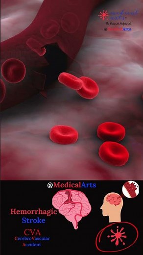 Hemorrhagic Stroke 🧠 CVA - Medical Arts 3d Animation