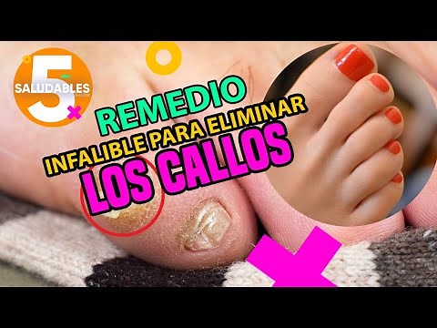 Remedio infalible para eliminar los callos | Salud180