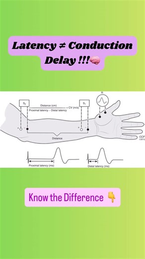 The EP Journey on Instagram: "Two signals can look slow… but only one means the heart is actually conducting slowly. 🔍 When analyzing electrograms during an EP study, not all “delays” are created equal: ⚡ Conduction Delay → Represents true slowing of electrical propagation between cells. 🔹 Seen as a longer interval between adjacent activation sites. 🔹 Usually due to reduced coupling, fibrosis, or diseased myocardium. 🧩 Electrogram Latency → Represents local activation delay within a region —