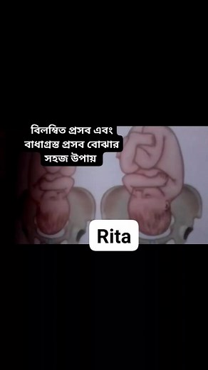 20K views · 332 reactions | Prolonged labour and obstructed labour সহজে বোঝার উপায়। #viralpost2025シ2025 #foryoupageシforyou #healthtips #highlighteveryone #midwife #pregnant | Midwife Abada sultana | Facebook