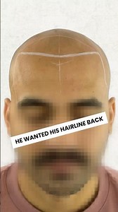 Amazing Hair Loss Transformation 🔥🔥