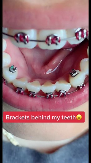 Back Braces Bracket - Types, Colors, and Placement