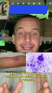 🦠INFECCIÓN POR EL VIRUS DEL HERPES SIMPLE (HSV-1 y HSV-2)🦠