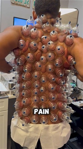 Why Do People Put Cups on Their Skin?