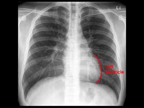 Chest x-ray interpretation