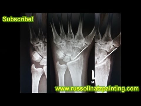 Scaphoid Nonunion Proximal pole fracture X-ray -Bone Graft with pin fixation / long arm plaster cast