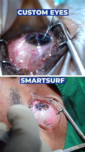 Custom Eyes Laser – Smarter, Safer & Sharper Vision 👁️ | Better Than Smart Surf LASIK?
