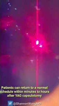 Everything you need to know about YAG LASER capsulotomy in 30 seconds.