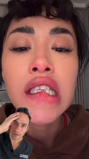 Luke Maxfield on Instagram: "Not A Snack. How To Fix Severely Damaged Lips ⬇️ Because the lips have little to no stratum corneum, the topmost protective layer covering our skin, the key is intense hydration. If you want a head start, not a sugar scrub, nothing aggressive, nothing with flavoring or allergens, but with Polyhydroxy Acids at most. Do that once per day for up to a week. Then, the most crucial stage. Layering hydration. After you get out of the shower, your skin is saturated. Humectan