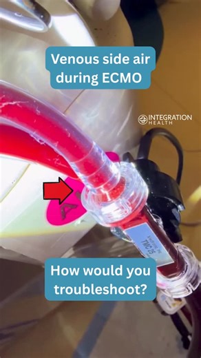 ECMO Advantage | 🫧 Seeing microbubbles upstream of the pump is one of those moments that should immediately slow everyone down. A few places to mentally... | Instagram
