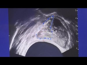 60% of prostate cancer patients are opting out of treatment & living just as long, study finds