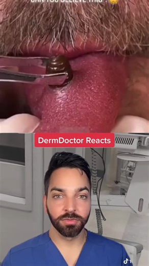 WHY MAKE THIS VIDEO?!@rorolchocolat #dermdoctor#splinter #dermdoctor #dermatologist #cyst