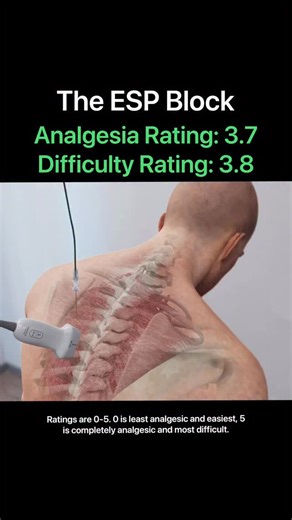 PNBschool - Anesthesia/Peripheral Nerve Blocks on Instagram: "The Erector Spinae Plane Block These ratings are only based on my personal experience. I have performed thousands of regional anesthesia techniques and taught hundreds of anesthesia professionals how to perform these blocks. I simply wanted to provide more information about these techniques to the new and/or average regionalists reading my content. A rating system, even if just an opinion, allows for a quick review and offers everyone