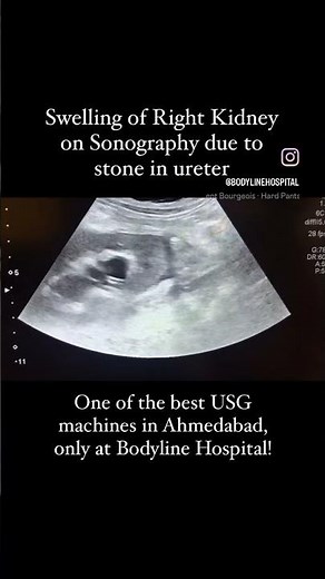 HYDRONEPHROSIS: Swelling of the right kidney as seen on sonography due to a ureteric stone!
