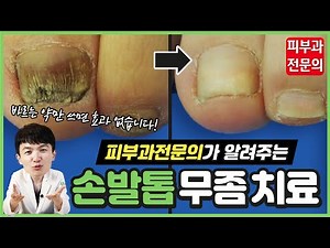 (sub)피부과전문의가 알려주는 정.확.한 손발톱무좀 치료법😎(먹는약,바르는약,핀포인트레이저,루눌라레이저)