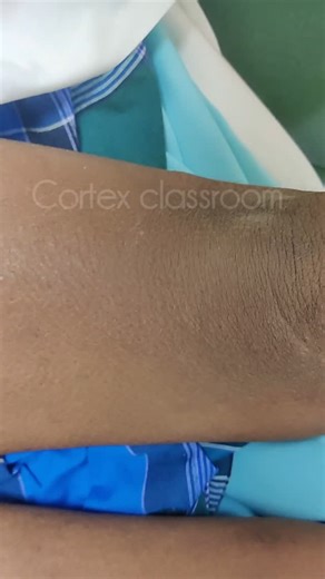 Dr. V. Poornam Naveena on Instagram: "Patellar clonus consists of a series of rhythmic up-and-down movements of the patella. Technique involves holding the upper border of the patella between your index finger and thumb and giving a sharp, sudden downward thrust. Some tips : 💎Face the foot end of the patient when you perform patellar clonus. 💎Be it right or left limb of the patient, use your dominant hand for eliciting the clonus. 💎Hold the downward pressure at the end of your movement. 💎Mos