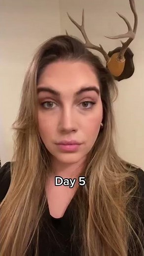 Baby Botox, before and after Botox facial, natural Botox, forehead lines, frown lines, wrinkle relax