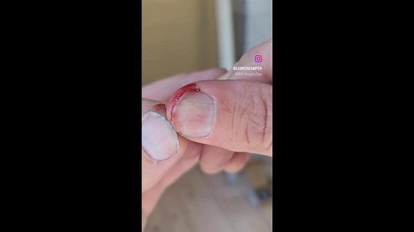 Man's painstaking removal of splinter from under his fingernail