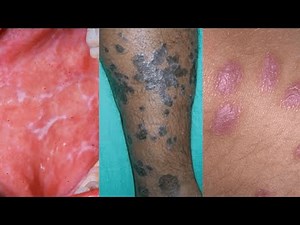 Lichen Planus Explained: Symptoms, Causes, Treatment, Diagnosis, Complications