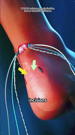 How Minimally Invasive Achilles Repair is Done? (3D Animation)
