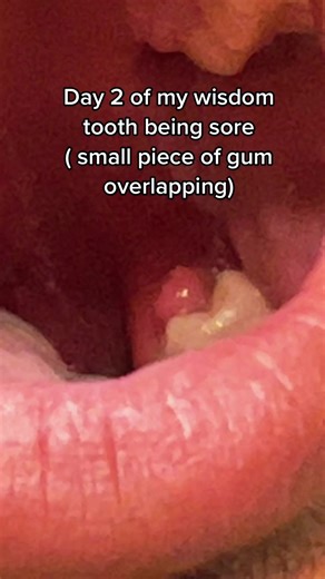 Home Remedies for Wisdom Tooth Pain Relief