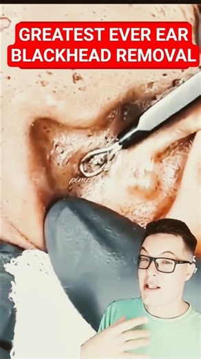 Stunning EAR BLACKHEAD REMOVAL #shorts