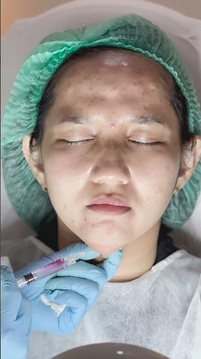 Lipo lifiting injection