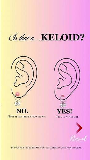 Is It a Keloid or an Irritation Bump? 👂✨ | Piercing Healing Explained by Eternal Jeweller