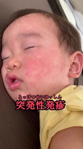 突発性発疹の症状と対処法