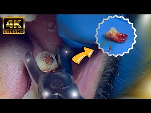 Extraction of Lower Wisdom Teeth FAST and GENTLE !